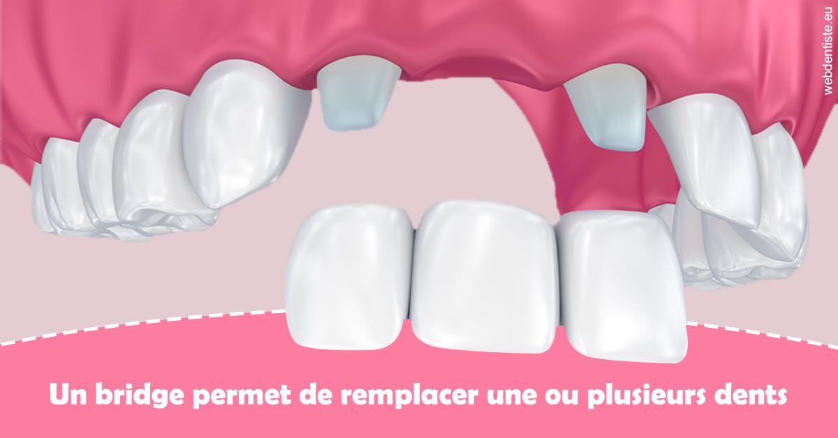 https://dr-philippe-nozais.chirurgiens-dentistes.fr/Bridge remplacer dents 2