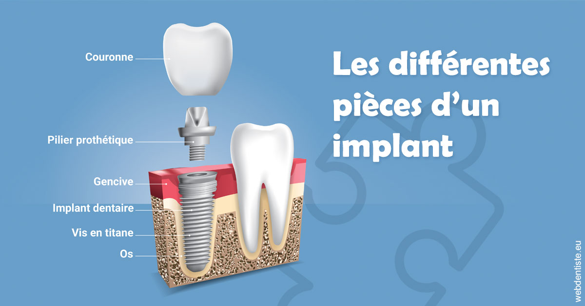 https://dr-philippe-nozais.chirurgiens-dentistes.fr/Les différentes pièces d’un implant 1