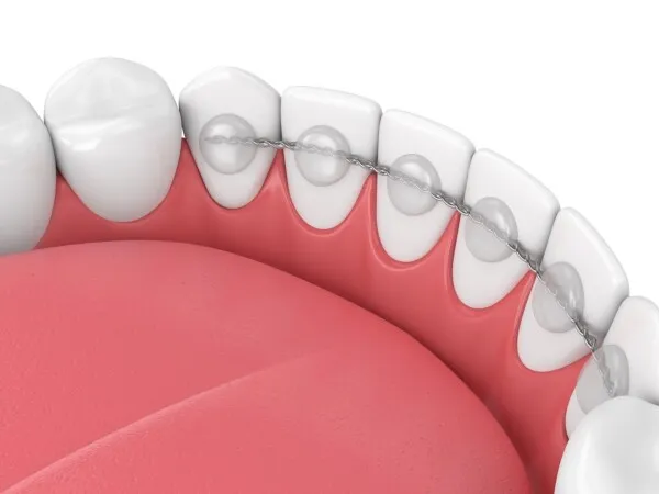 Période de contention orthodontique